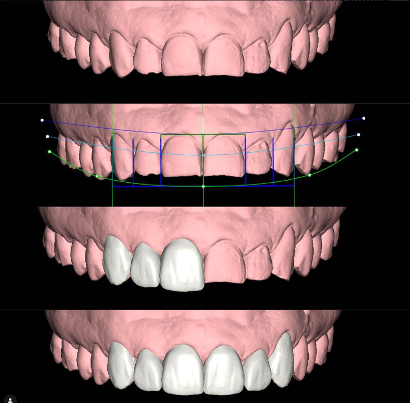 Simulação 3D de Planejamento Digital do Sorriso